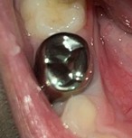 After stainless steel crown